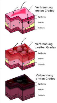 Wunden<br>