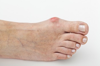 Bild von Hallux valgus